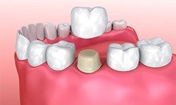 3D image of dental crown