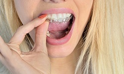 close-up of a woman putting an Invisalign aligner in her mouth 