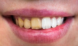 Close up of before and after teeth whitening