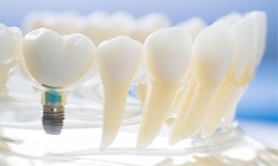model of dental implant