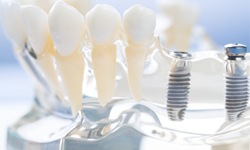 Dental implant posts