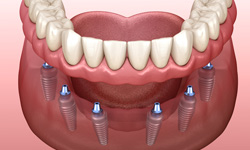 Illustration of six implants anchoring full set of lower dentures