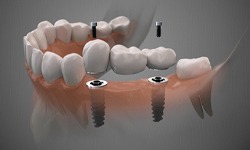Digital illustration of implant dental bridge in Middleburg Heights