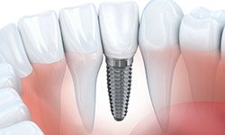 Animation of implant supported dental crown