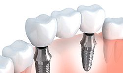 Animation of implant supported fixed bridge