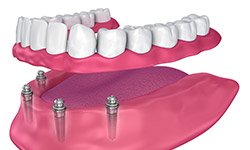 Animation of implant supported denture