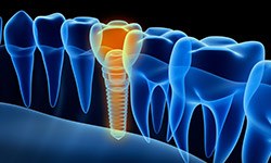 Animation of implant supported dental crown