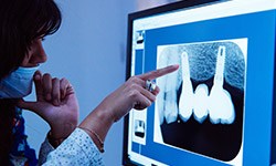 Dental x-rays on computer screen