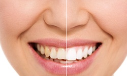 Before and after image of teeth whitening in Middleburg Heights