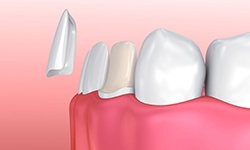 diagram of veneer being placed over bottom front tooth 