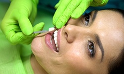 dentist placing veneers in woman’s mouth 