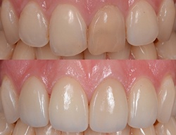 Before and after veneers in Middleburg Heights