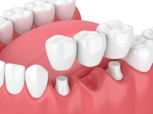 model of dental bridge