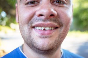 man with a chipped tooth in cleveland