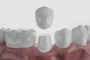 a digital image of a dental crown